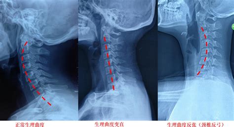 反弓|颈椎反弓怎么治疗和纠正